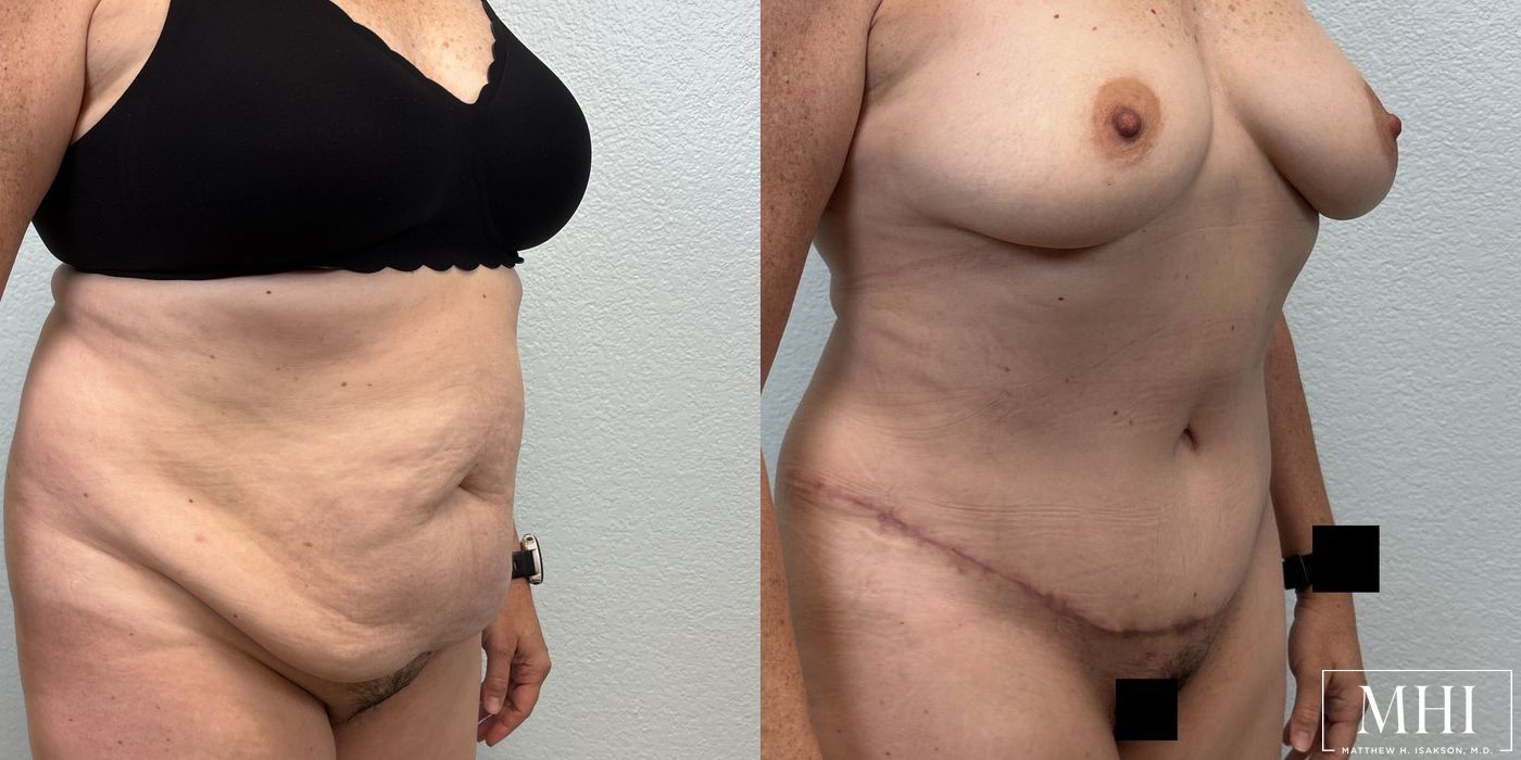 Tummy Tuck - Thumbnail 2