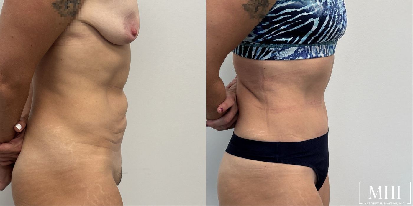 Tummy Tuck - Thumbnail 5