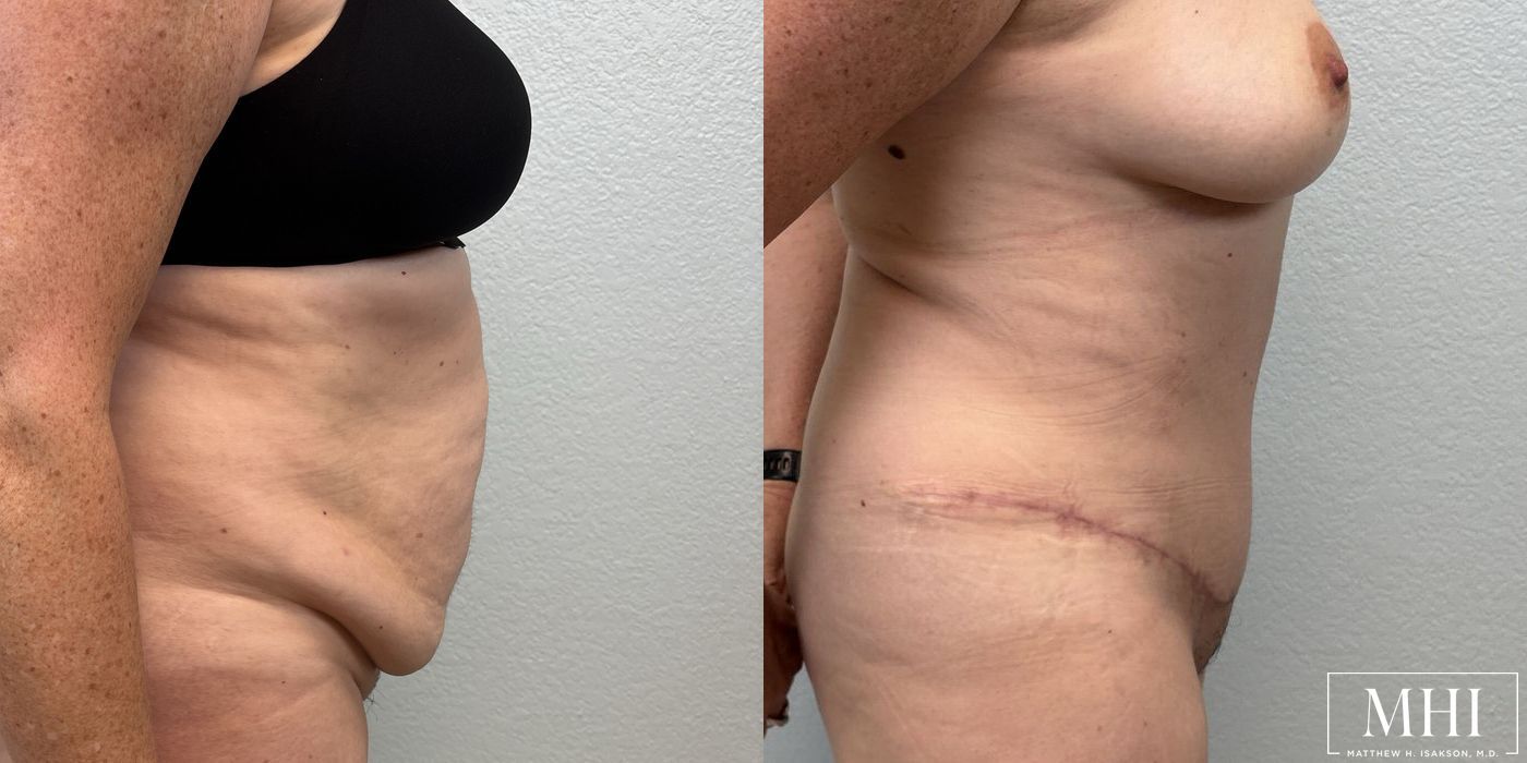 Tummy Tuck - Thumbnail 3