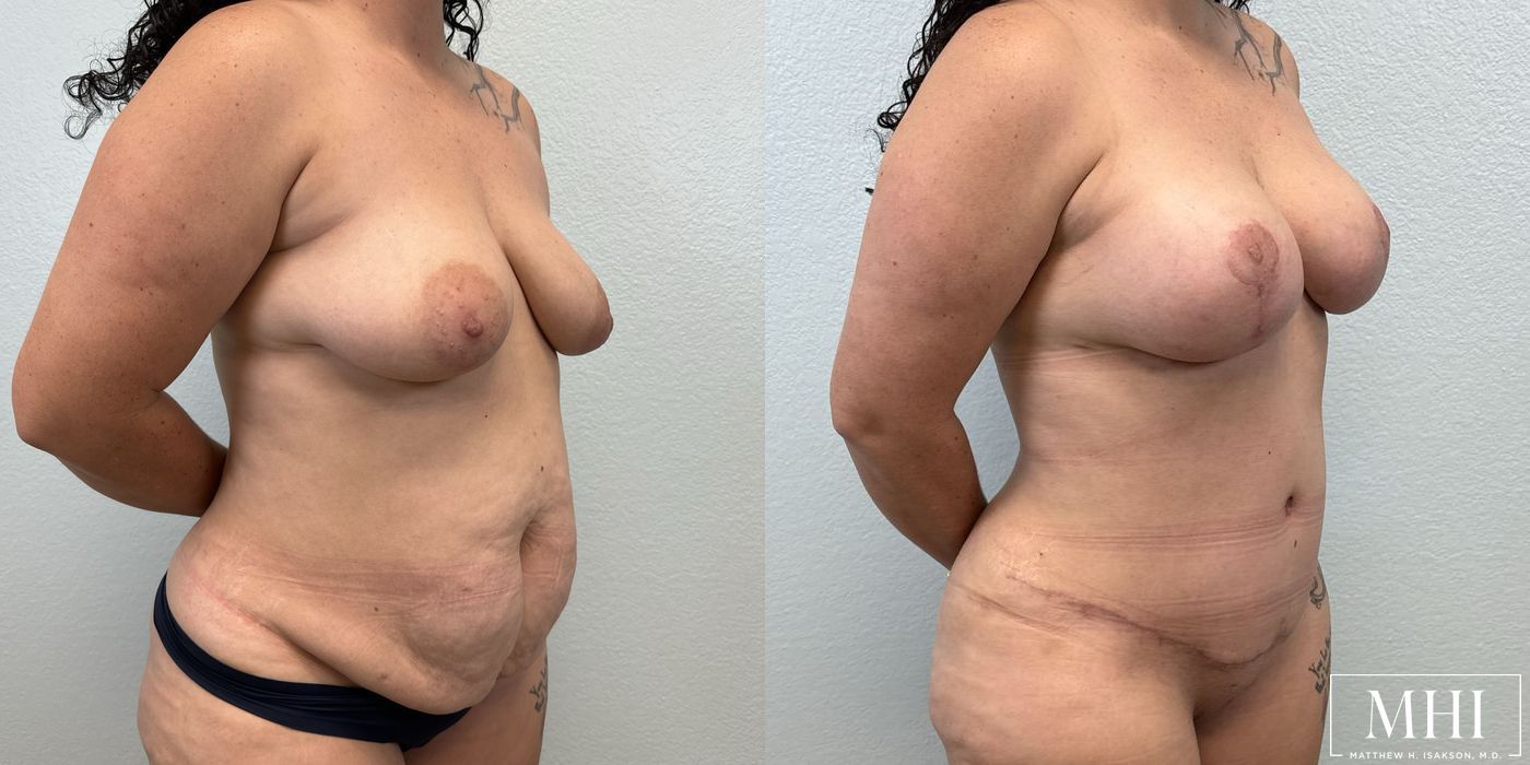 Breast Lift - Thumbnail 4