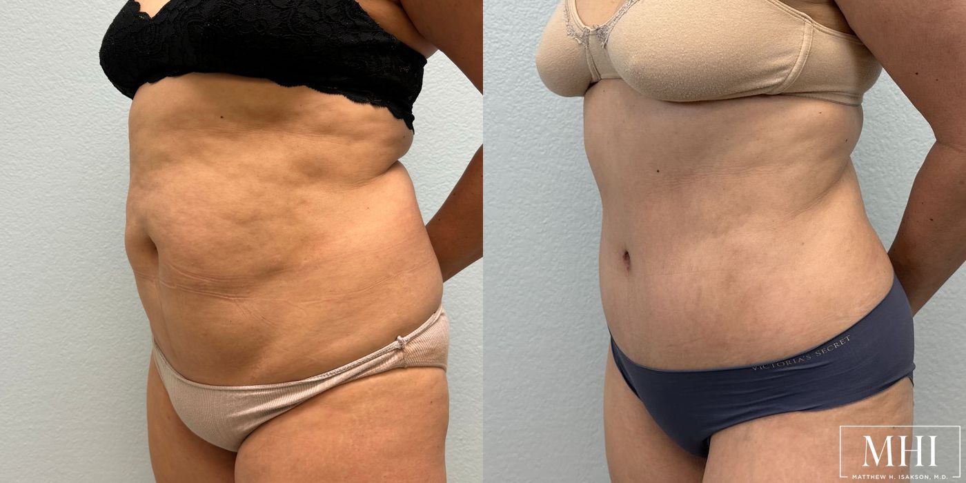 Tummy Tuck - Case 12387