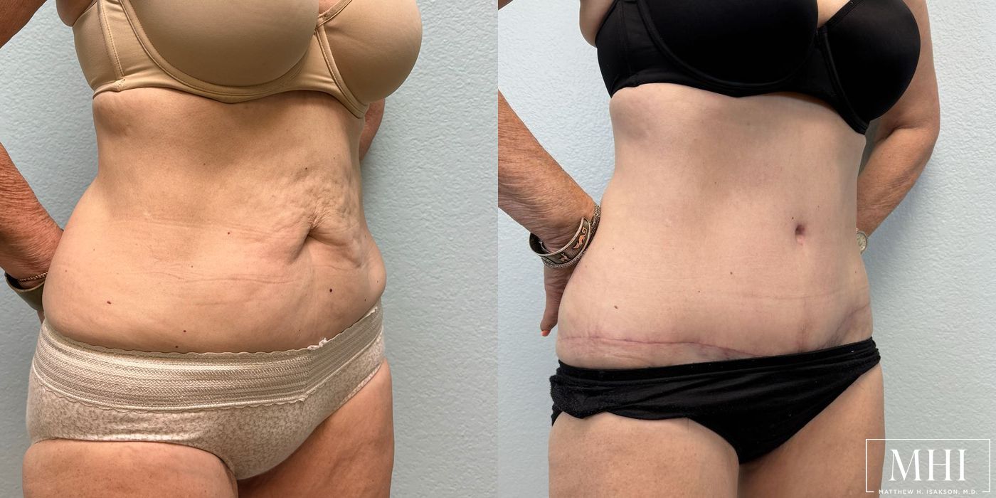 Tummy Tuck - Thumbnail 4