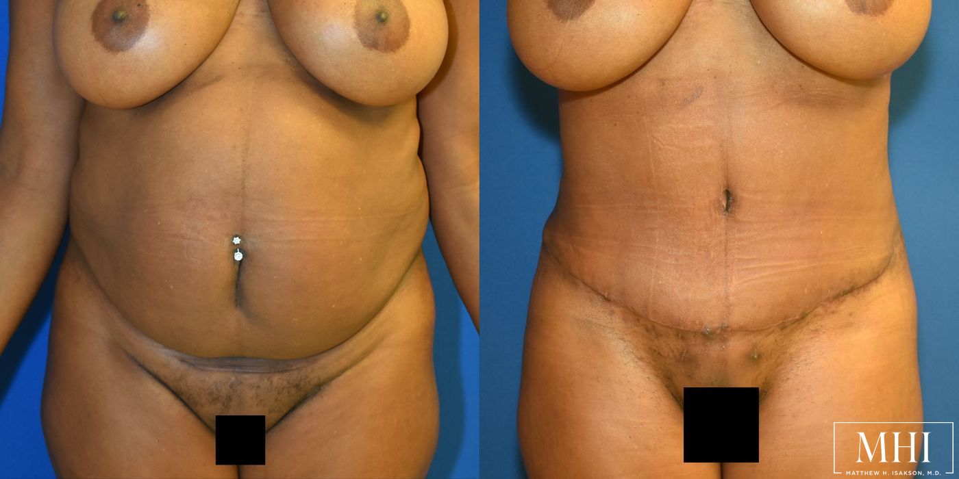 Tummy Tuck - Thumbnail 3