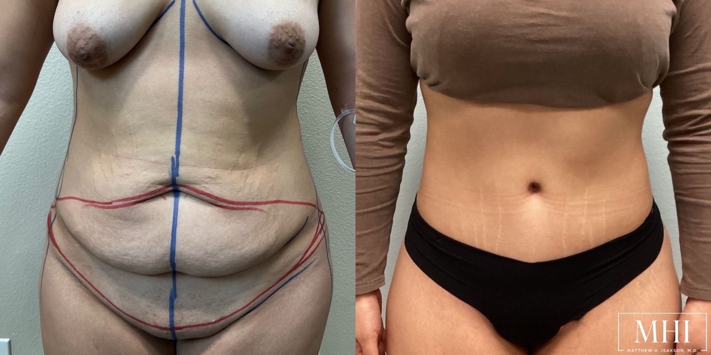 Tummy Tuck - Case 12394
