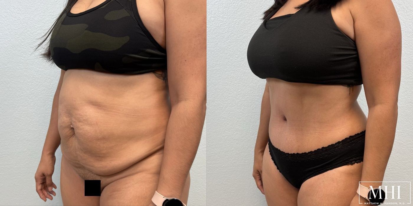 Tummy Tuck - Thumbnail 2