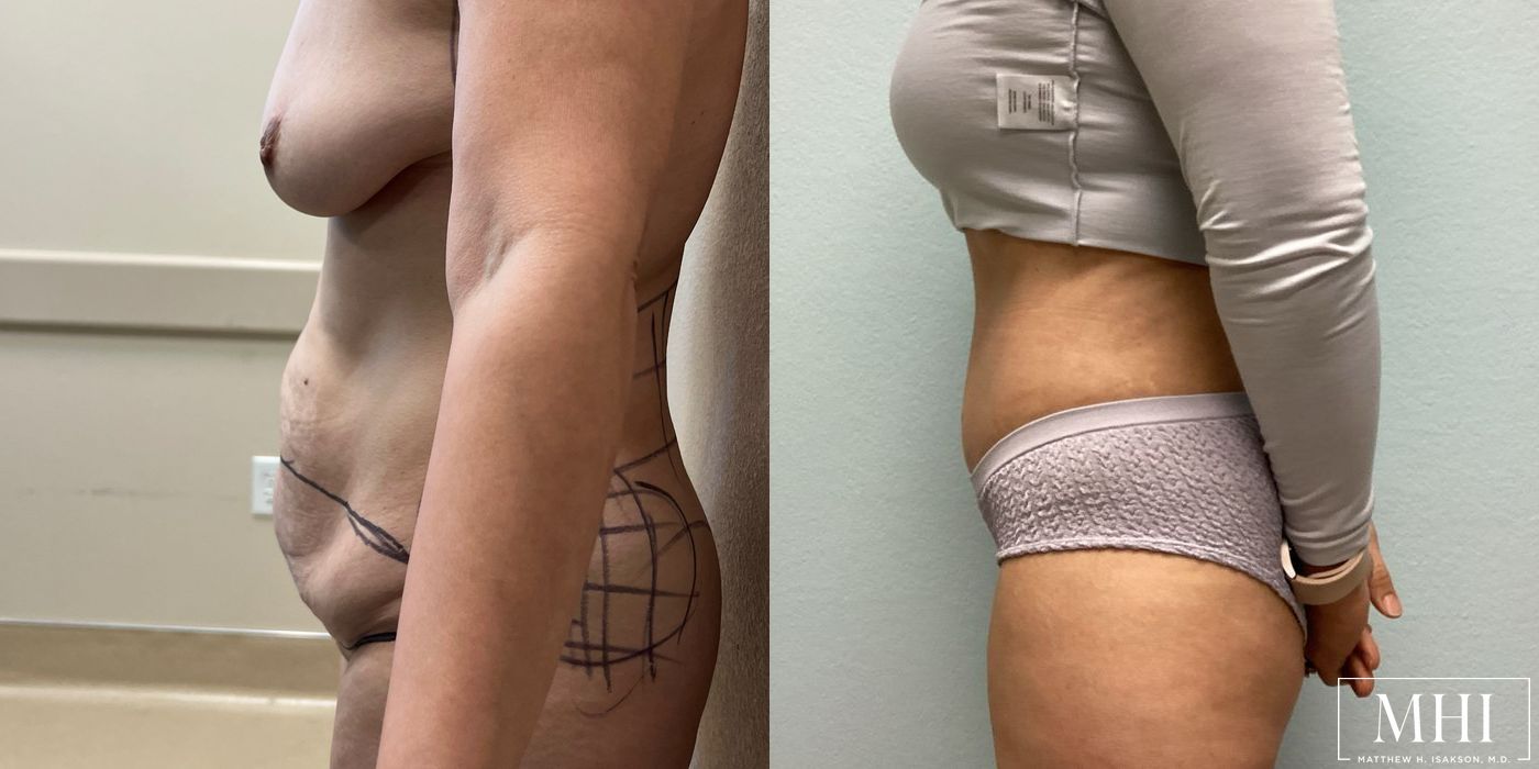 Tummy Tuck - Thumbnail 3