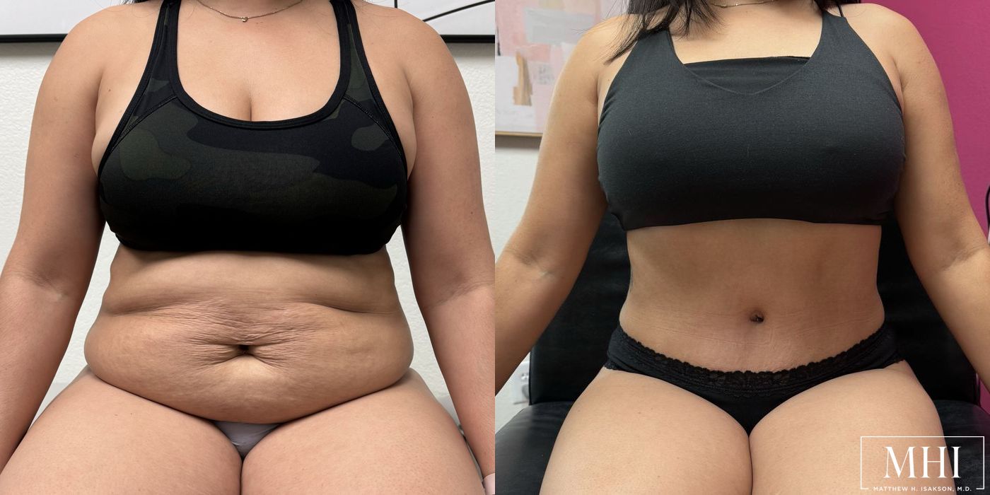 Tummy Tuck - Thumbnail 6