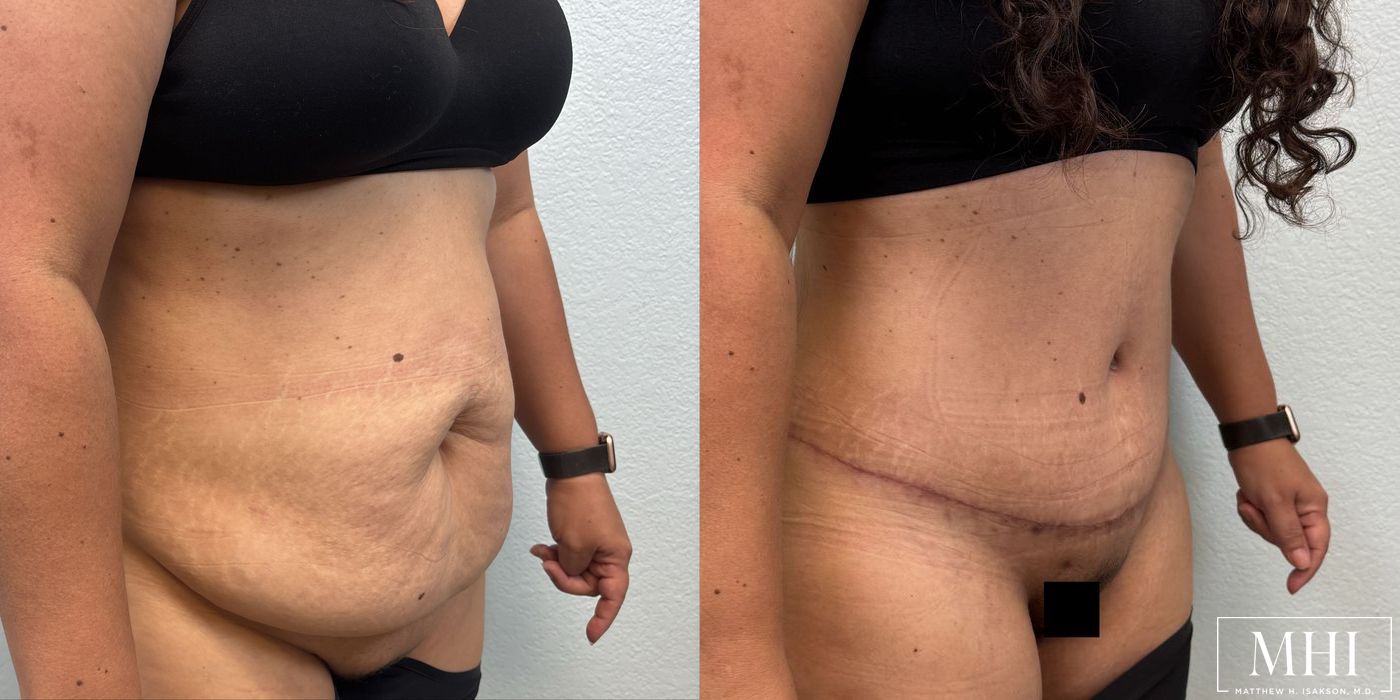 Tummy Tuck - Thumbnail 4