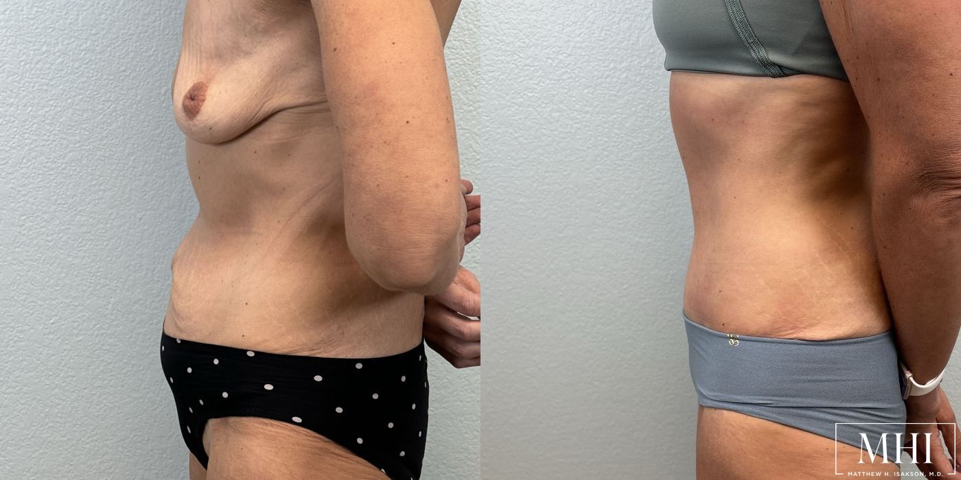 Tummy Tuck - Thumbnail 3