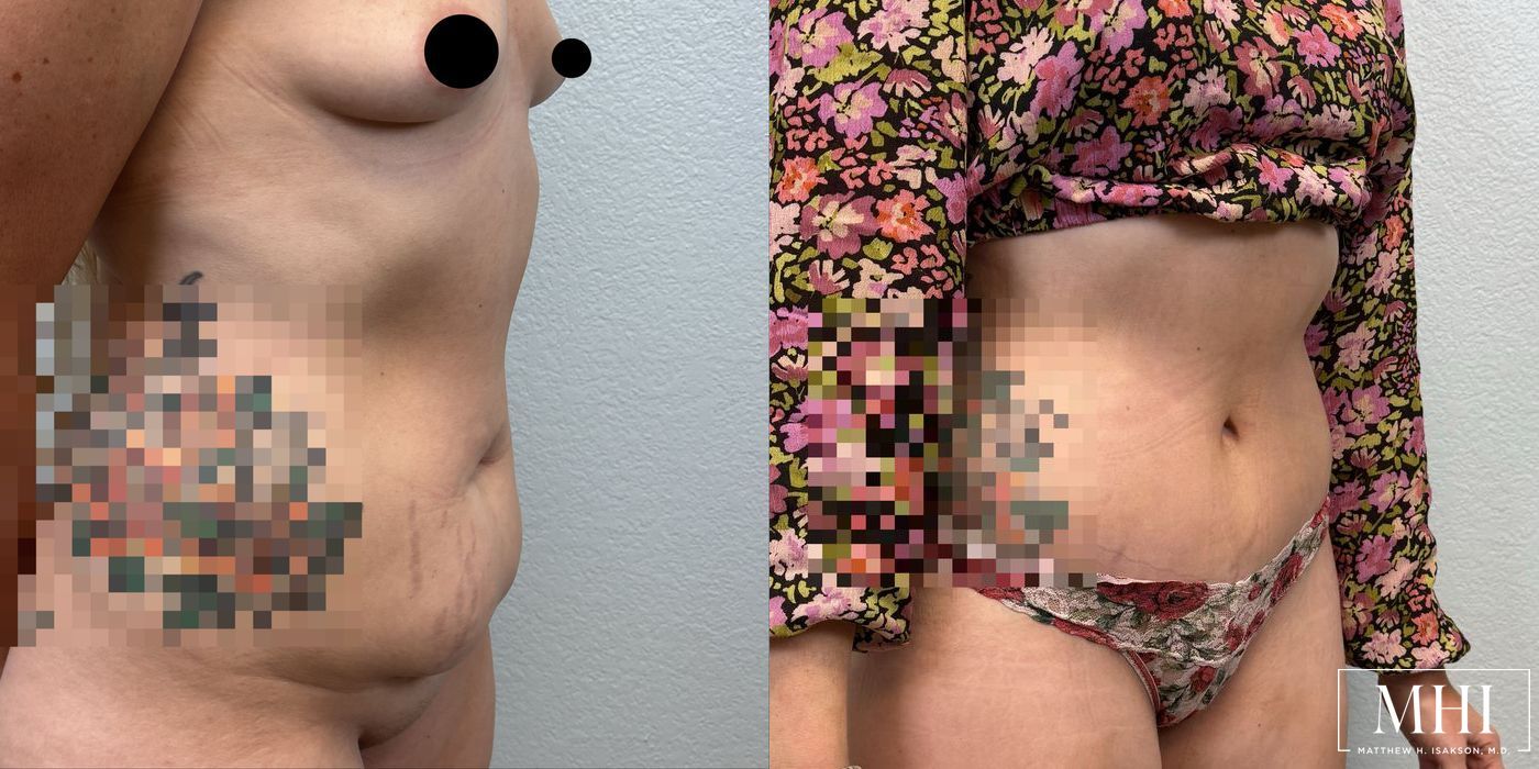 Tummy Tuck - Thumbnail 4