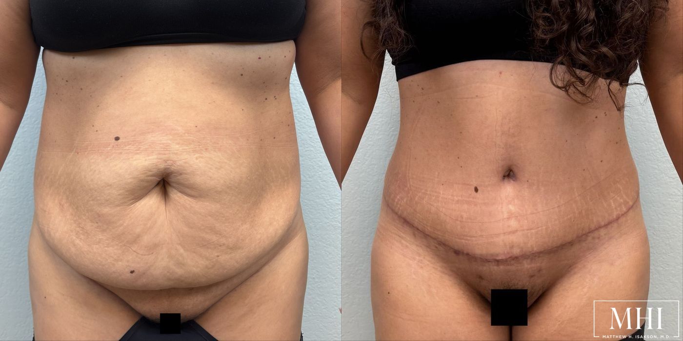 Tummy Tuck - Case 12098