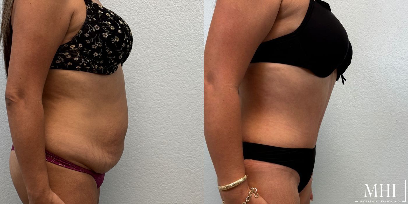 Tummy Tuck - Thumbnail 5