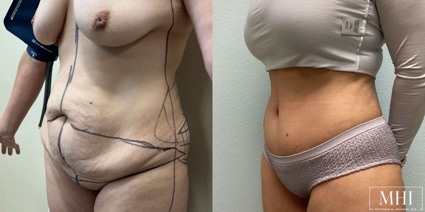 Tummy Tuck - Thumbnail 2