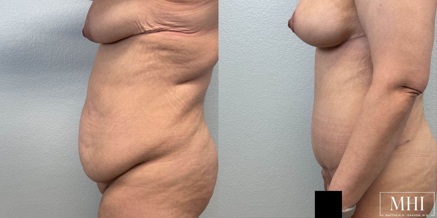 Tummy Tuck - Thumbnail 5