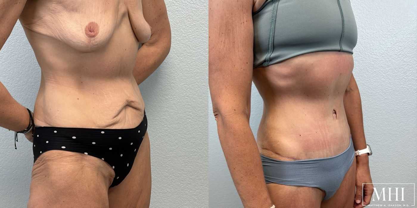 Tummy Tuck - Thumbnail 4