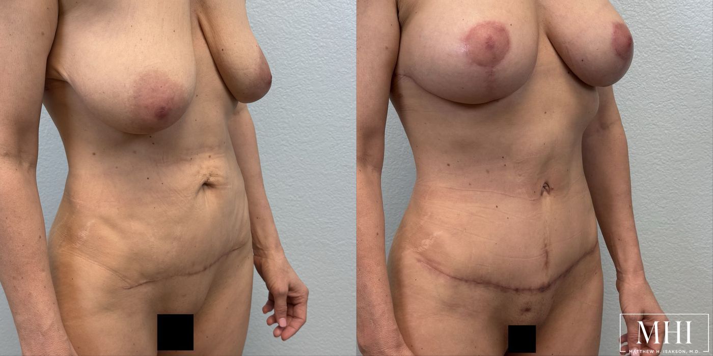 Tummy Tuck - Thumbnail 2