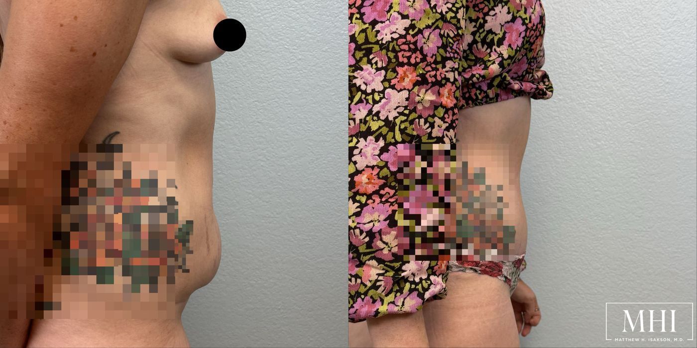 Tummy Tuck - Thumbnail 5