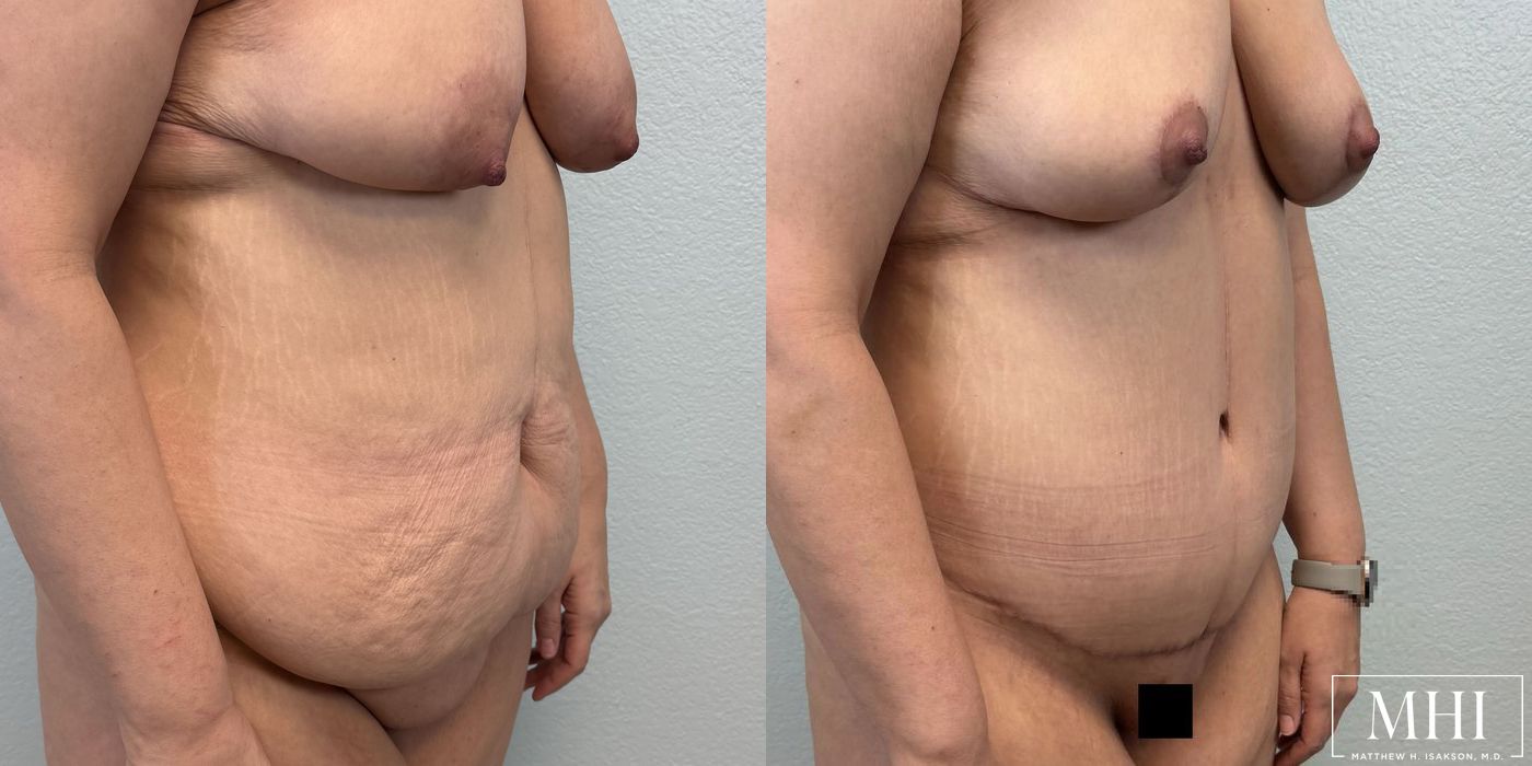 Tummy Tuck - Case 12384