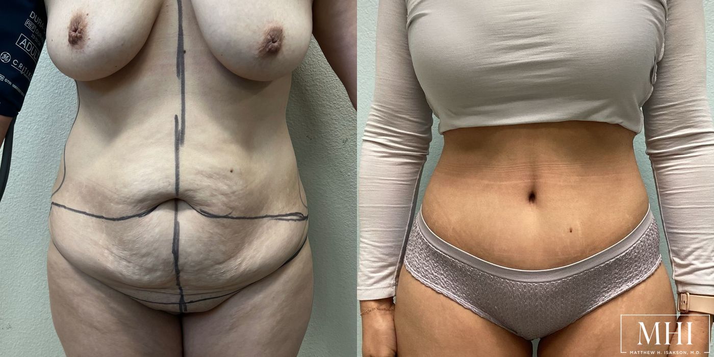 Tummy Tuck - Case 12393