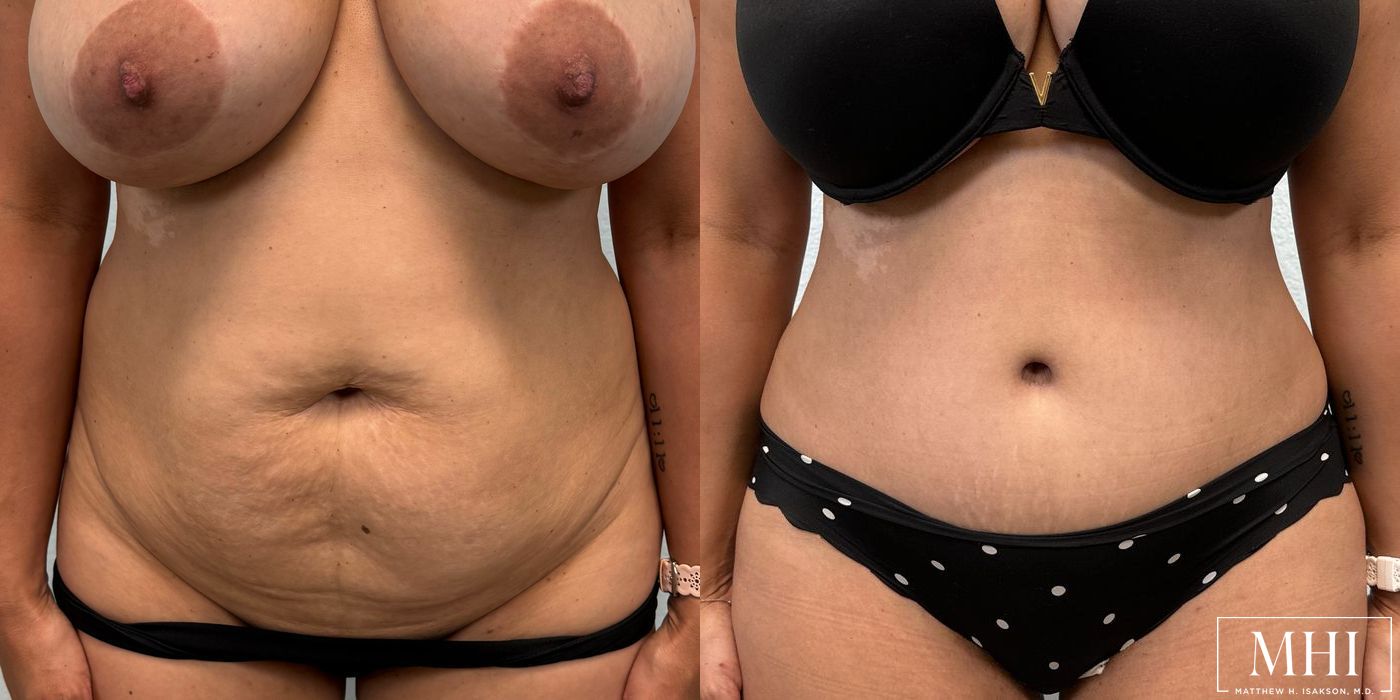 Tummy Tuck - Case 12395