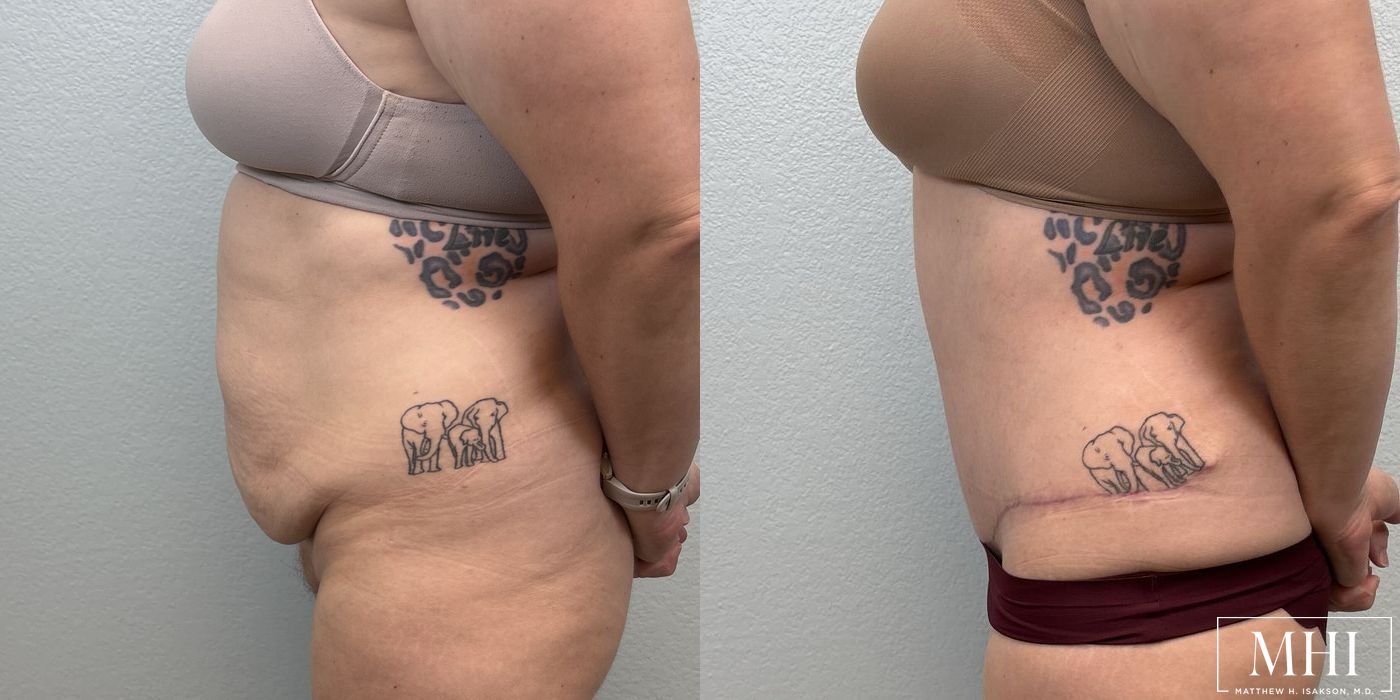 Tummy Tuck - Thumbnail 5