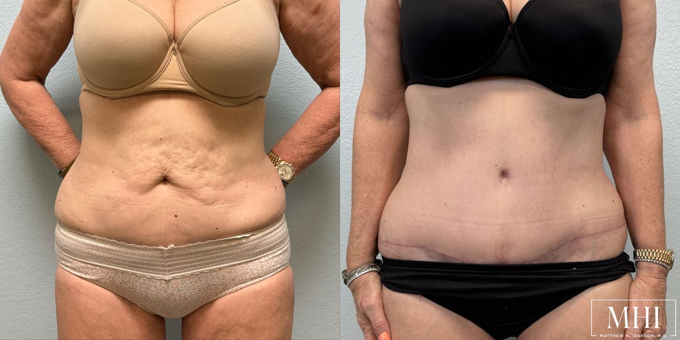 Tummy Tuck - Case 12392