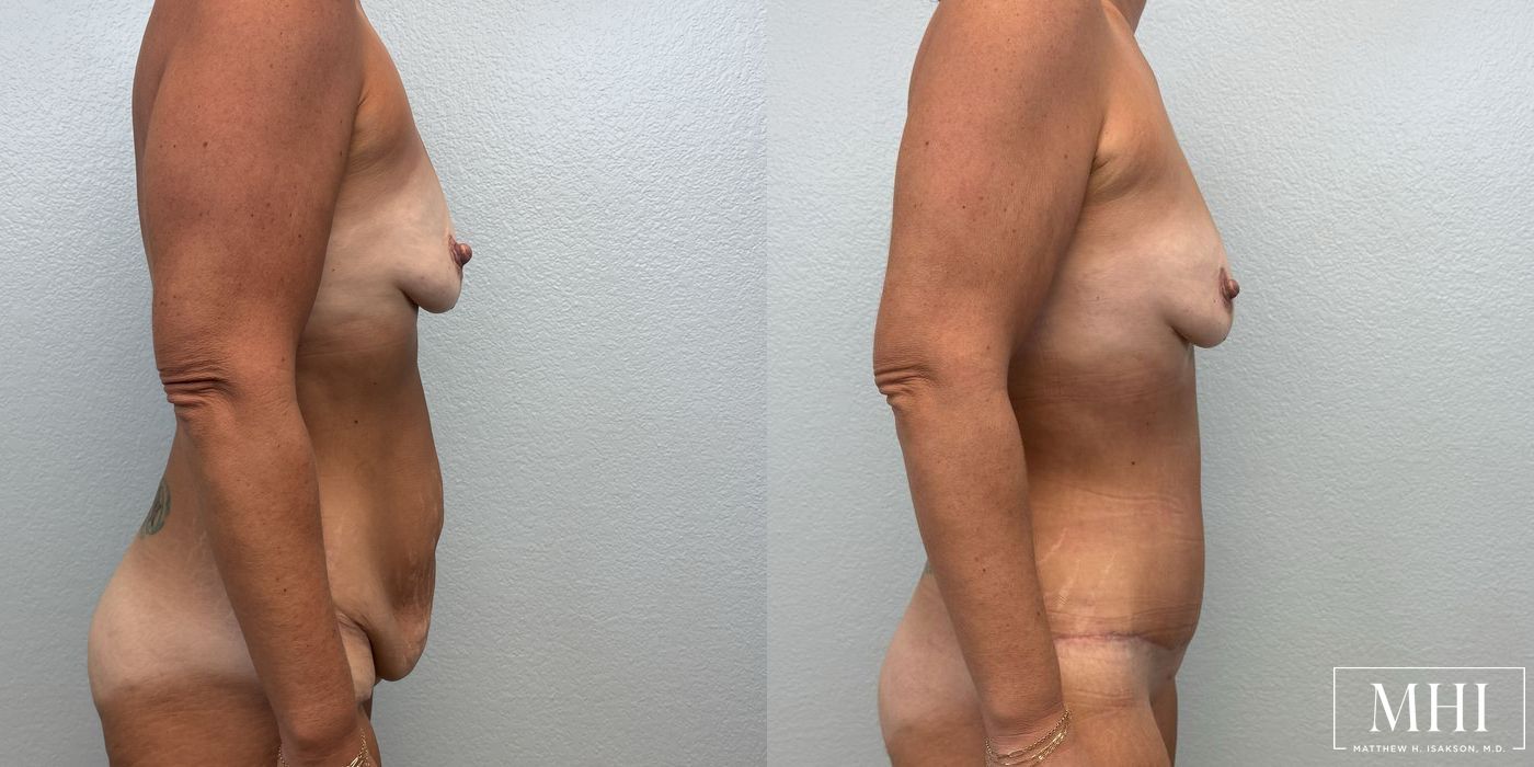 Tummy Tuck - Thumbnail 5