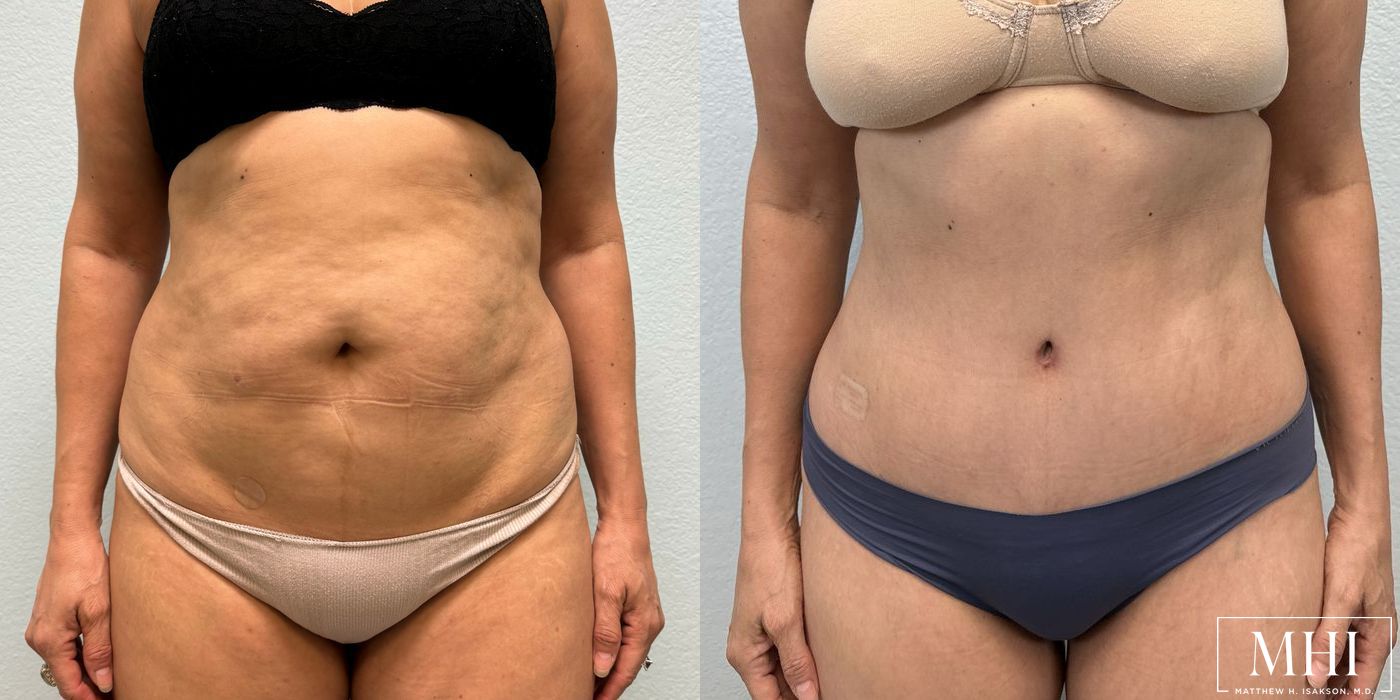 Tummy Tuck - Thumbnail 5