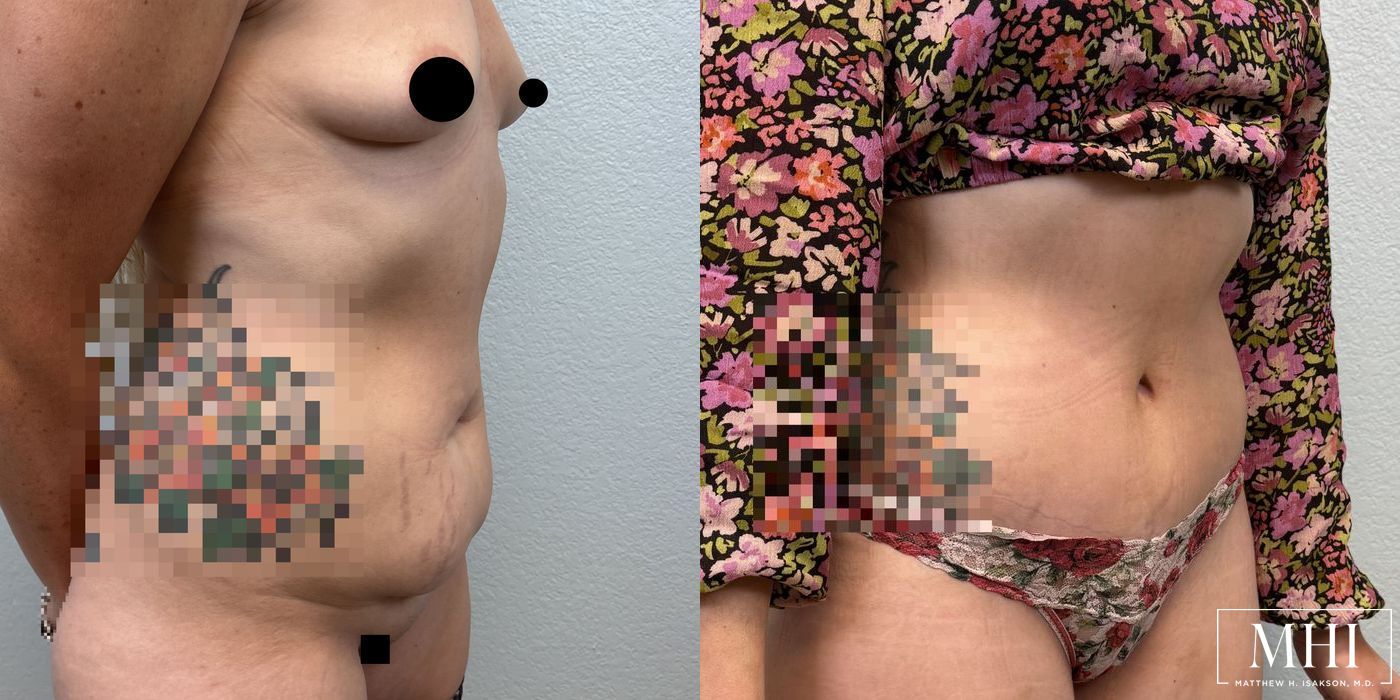 Tummy Tuck - Thumbnail 2