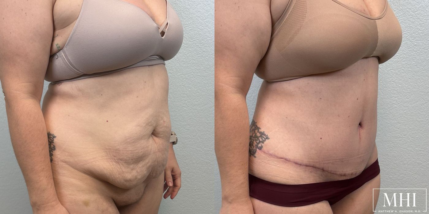 Tummy Tuck - Thumbnail 2