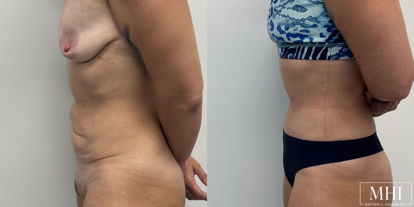 Tummy Tuck - Thumbnail 3