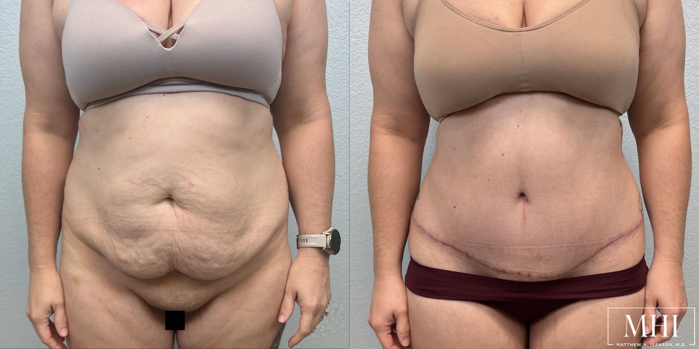 Tummy Tuck - Thumbnail 3