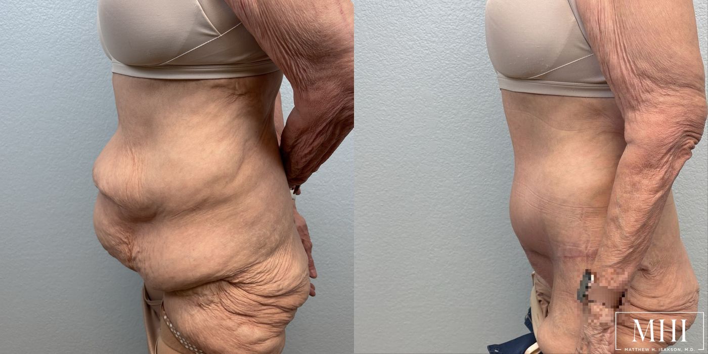 Tummy Tuck - Thumbnail 3