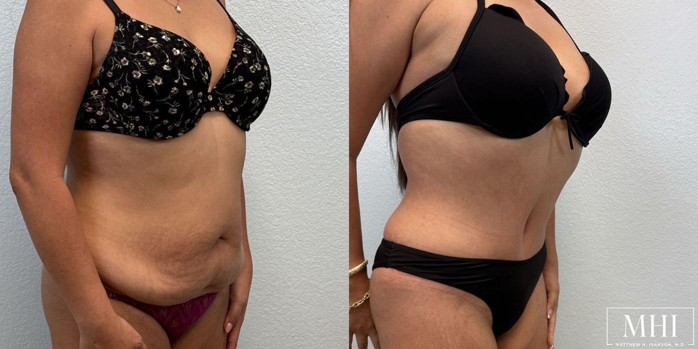 Tummy Tuck - Thumbnail 4