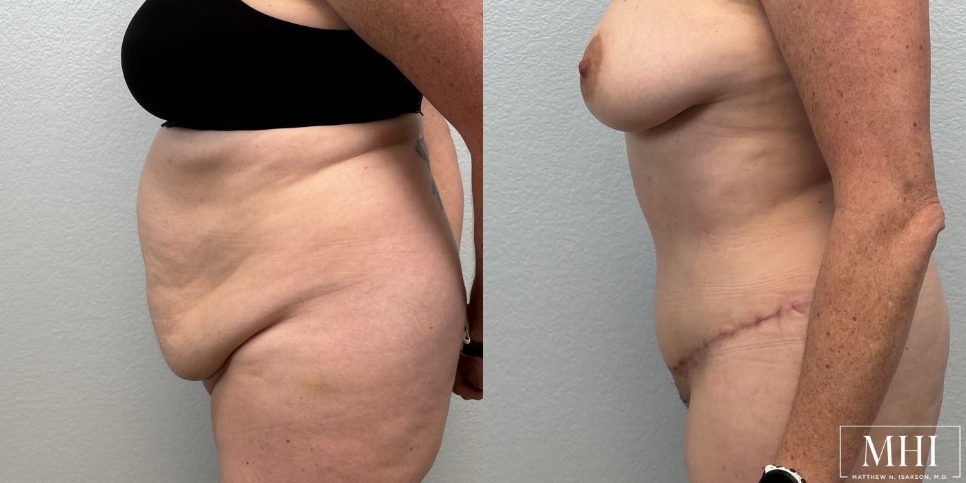 Tummy Tuck - Thumbnail 5