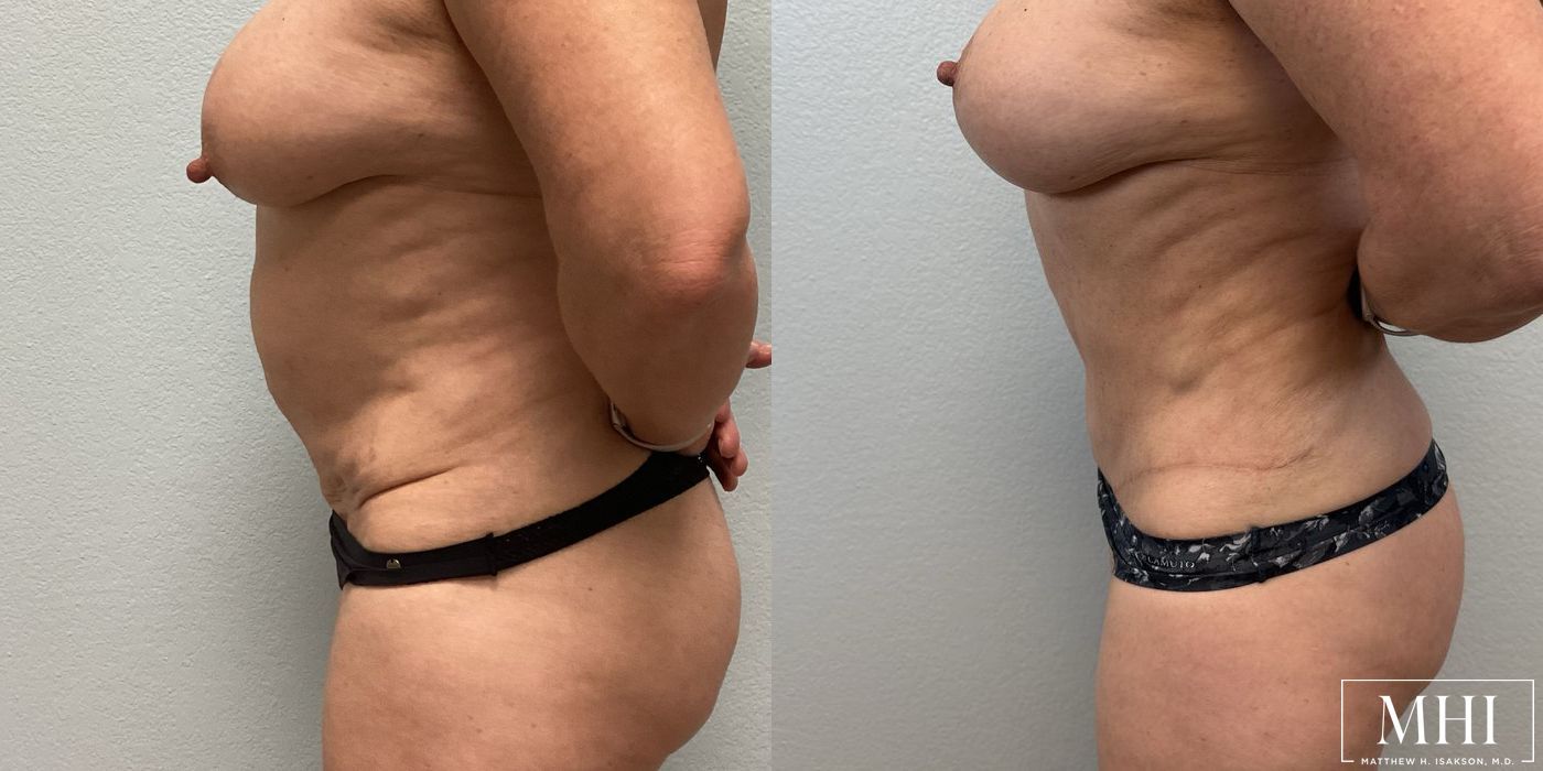 Tummy Tuck - Thumbnail 5