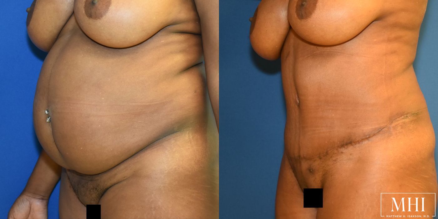 Tummy Tuck - Thumbnail 4