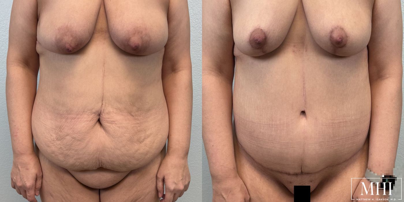 Tummy Tuck - Thumbnail 3