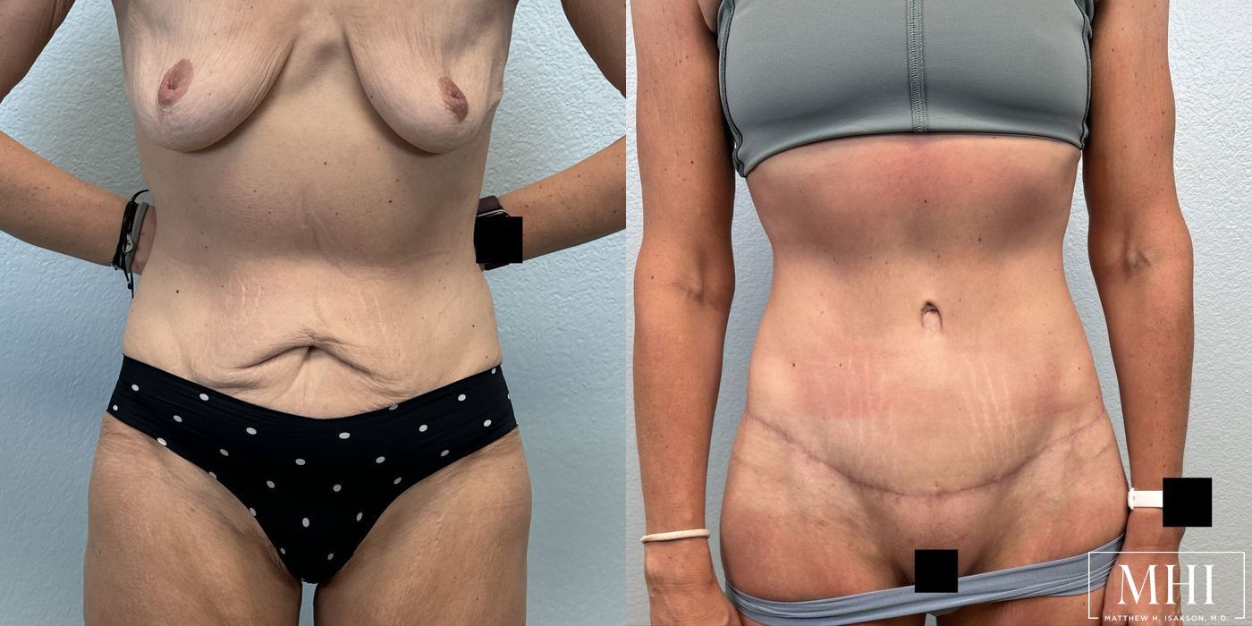 Tummy Tuck - Case 12397