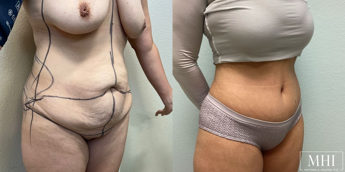 Tummy Tuck - Thumbnail 4