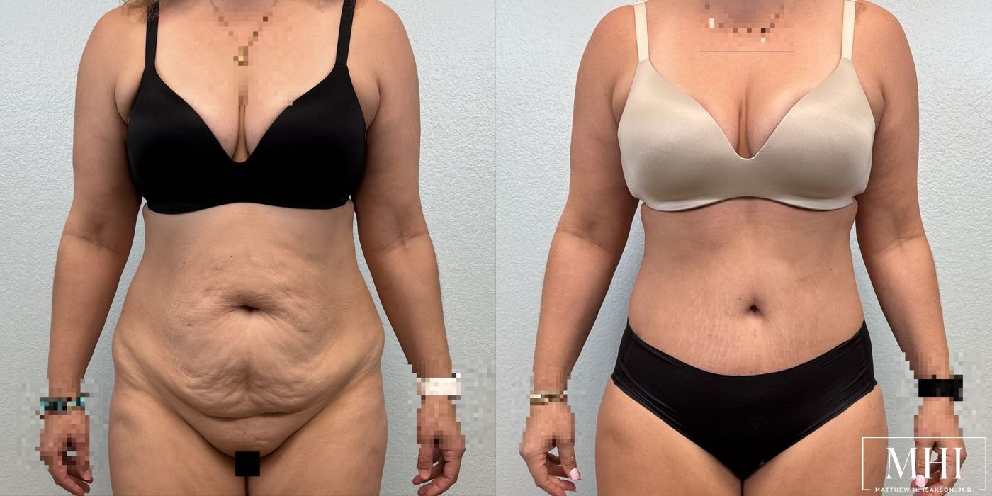 Lower Body Lift Belt Lipectomy - Case 12063