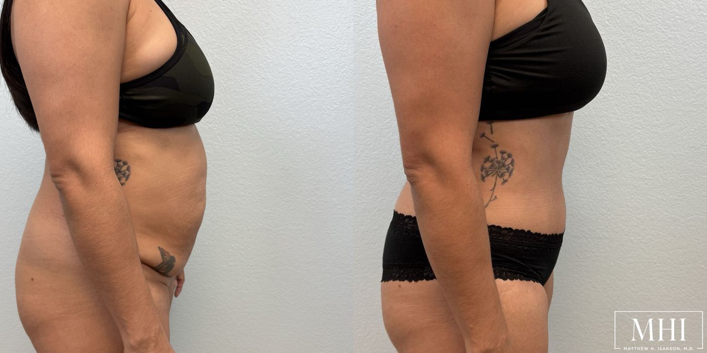 Tummy Tuck - Thumbnail 5