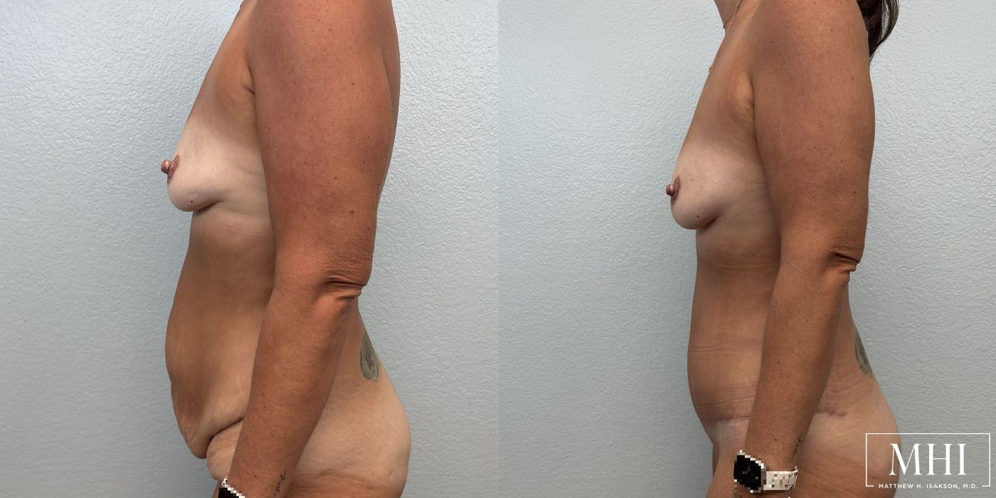 Tummy Tuck - Thumbnail 2