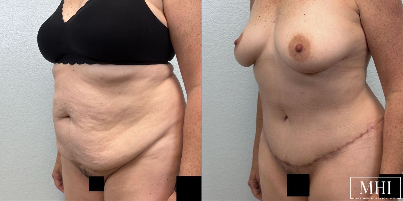 Tummy Tuck - Thumbnail 4