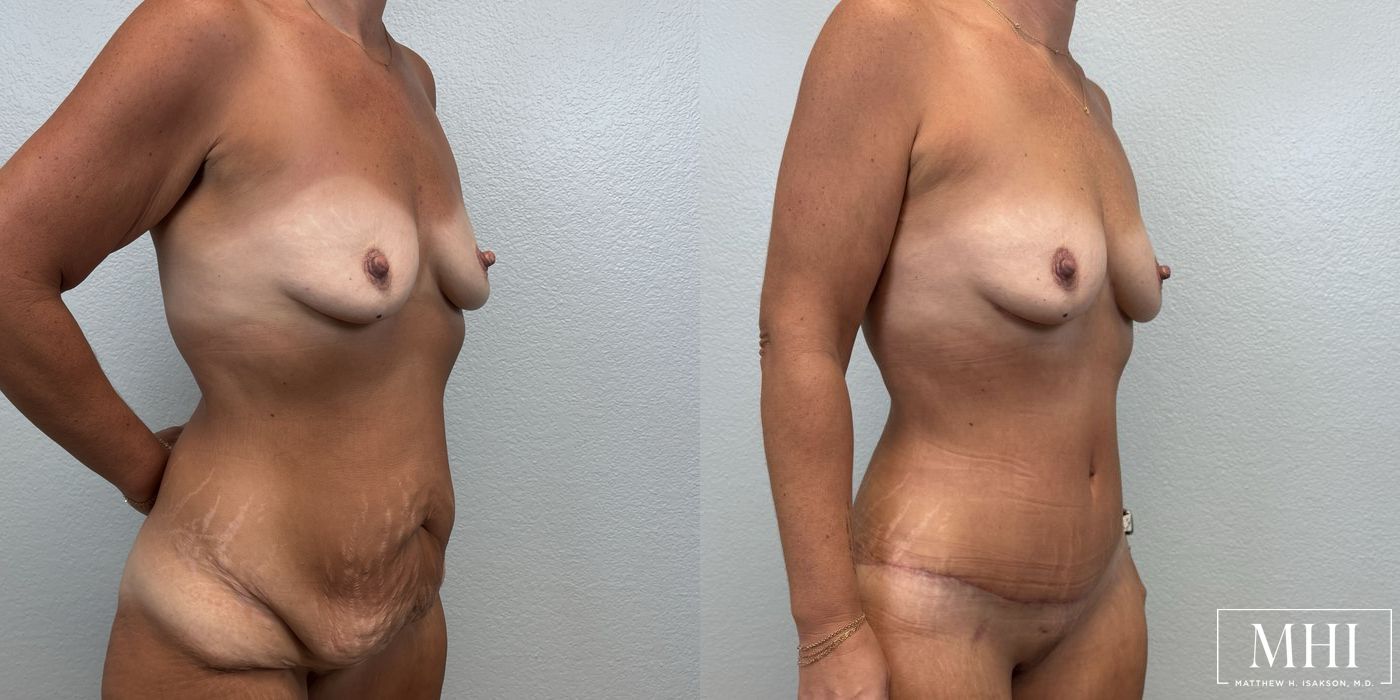 Tummy Tuck - Thumbnail 4