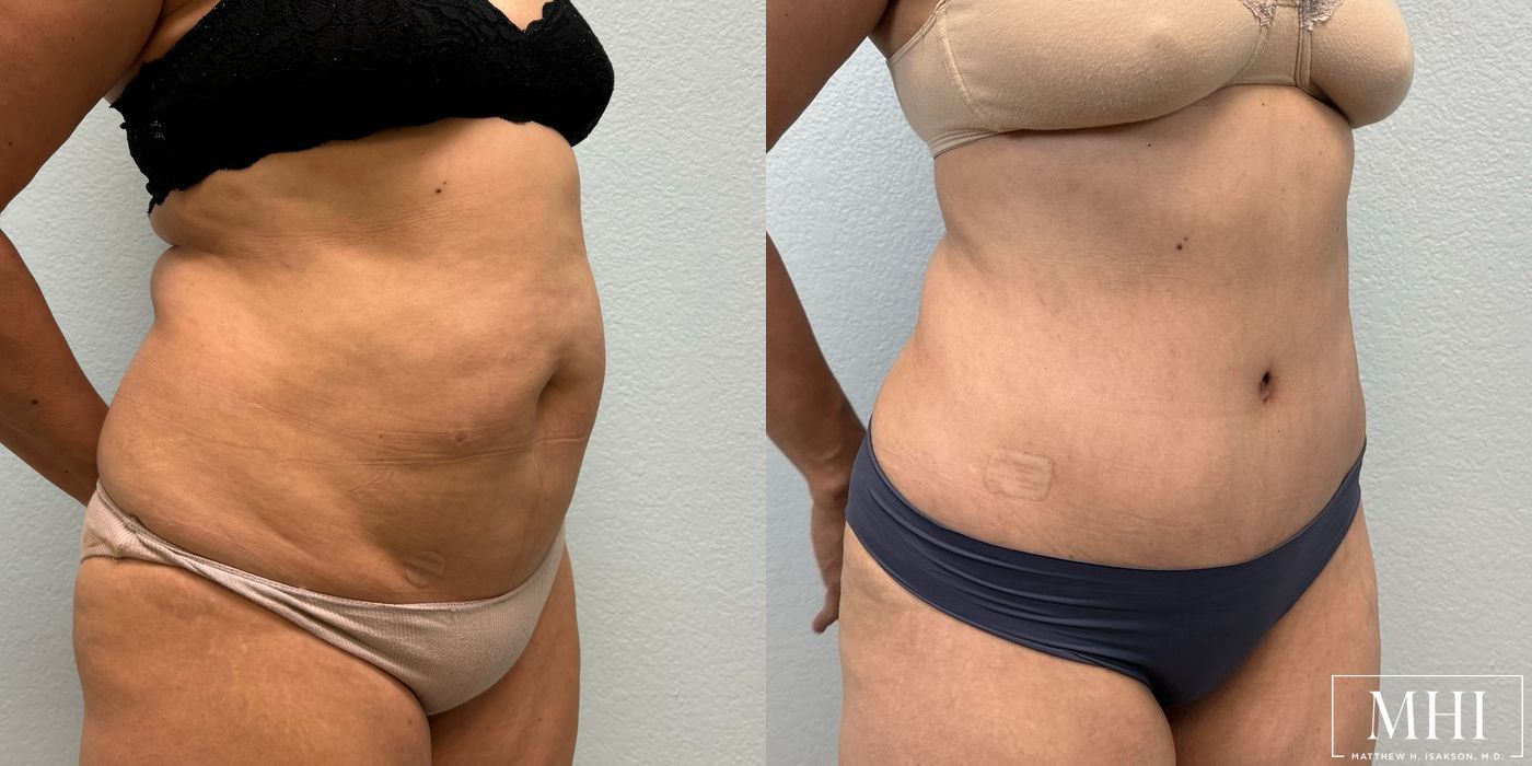 Tummy Tuck - Thumbnail 3