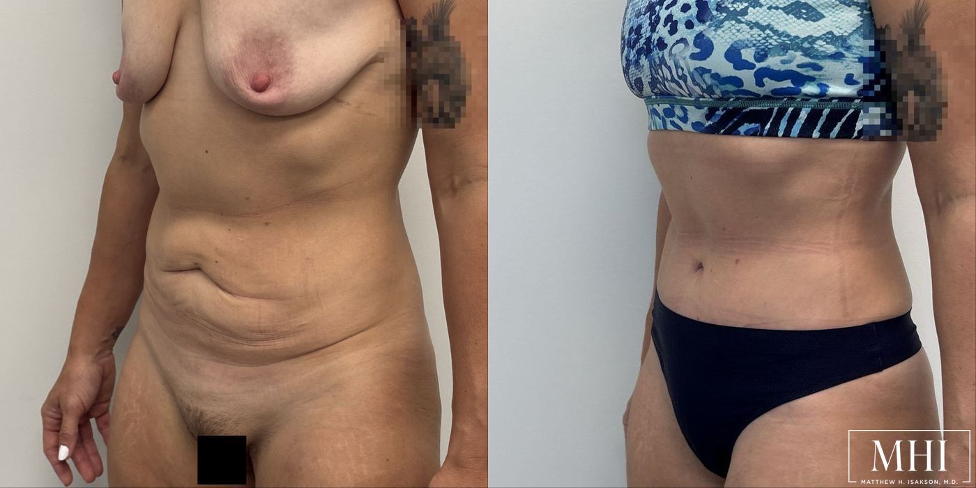 Tummy Tuck - Thumbnail 2