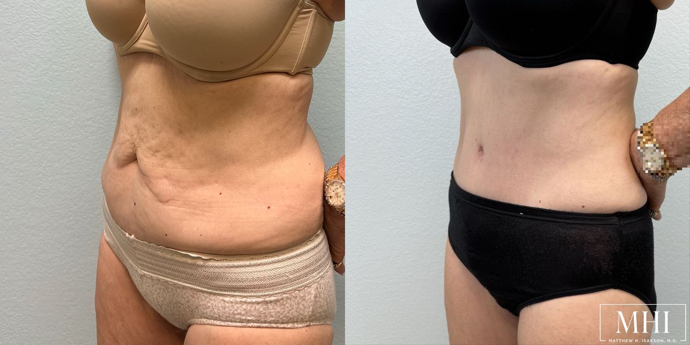 Tummy Tuck - Thumbnail 2