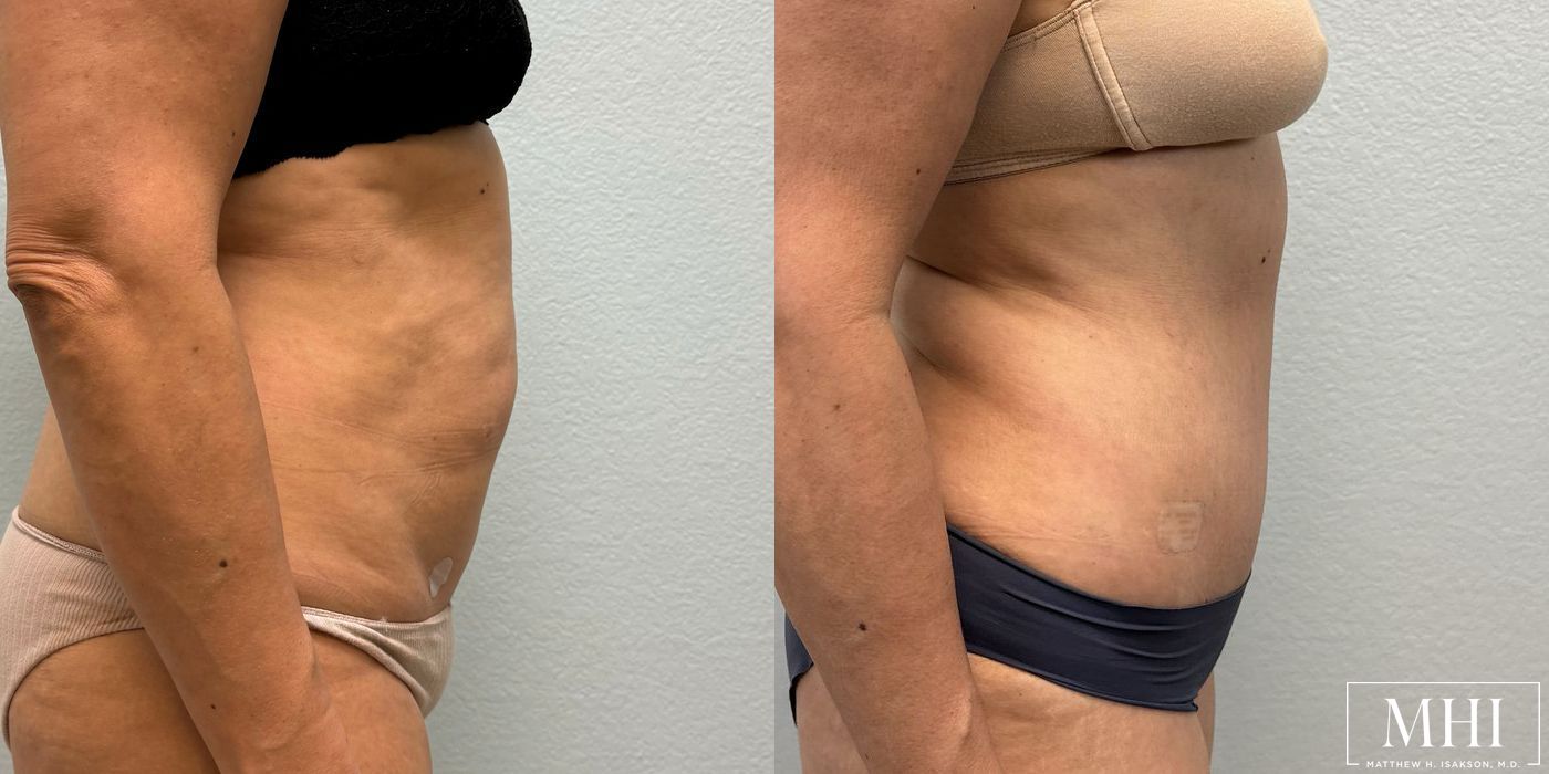 Tummy Tuck - Thumbnail 4