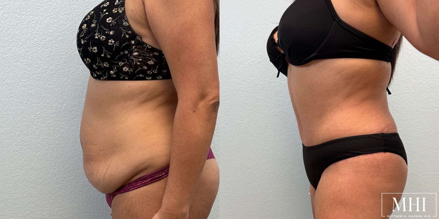 Tummy Tuck - Thumbnail 3